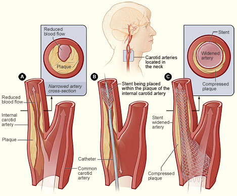 Stroke Care | Neurovascular Care | MaineHealth